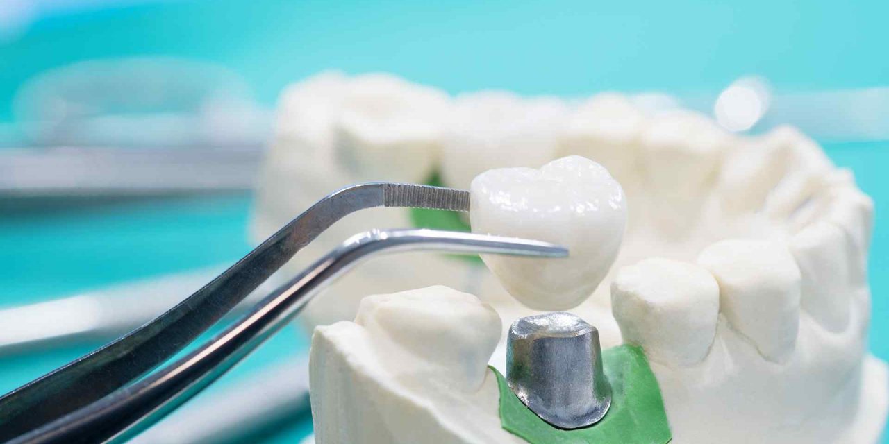 Wouldn’t it be enough if I have all my teeth extracted and get dentures? Then I’ll have perfectly straight teeth!